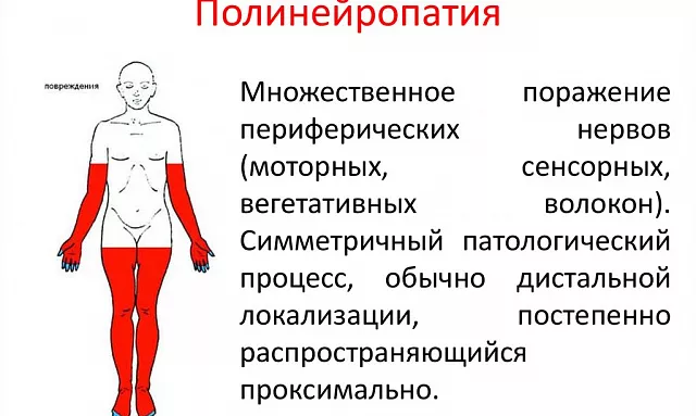 Полинейропатия нижних и верхних конечностей: причины, симптомы и методы лечения